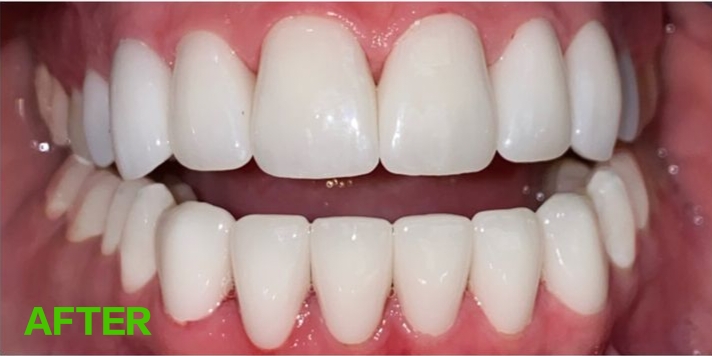 Teeth after alignment correction treatment