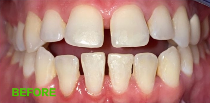 Teeth before alignment correction treatment