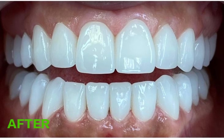 Teeth after smile transformation treatment