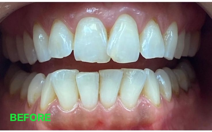 Teeth before smile transformation treatment