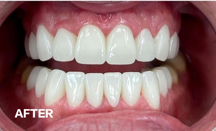 Teeth after professional whitening treatment
