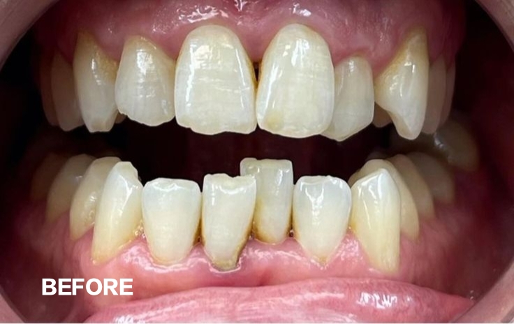 Teeth before professional whitening treatment